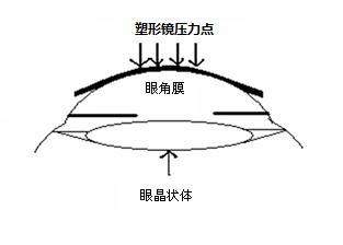 角膜塑形用硬性透氣接觸鏡說(shuō)明書(shū)編寫(xiě)指導(dǎo)原則（2020年修訂版）（2020年第47號(hào)）(圖1)