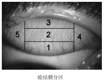 軟性接觸鏡臨床試驗(yàn)指導(dǎo)原則（2018年第51號）(圖2)